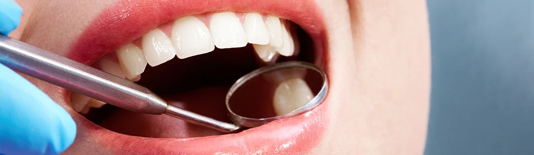 Quickly Perfect Your Smile with Dental Bonding in Tacoma WA